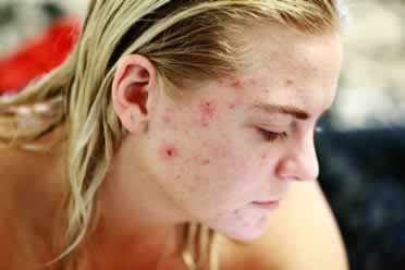 Acne (Symptoms, Causes, Treatments)